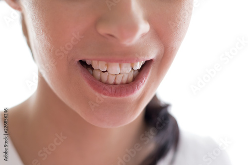 Problem teeth at the young girl. A curve row and the wrong bite an occasion to visit the dentist and the orthodontist