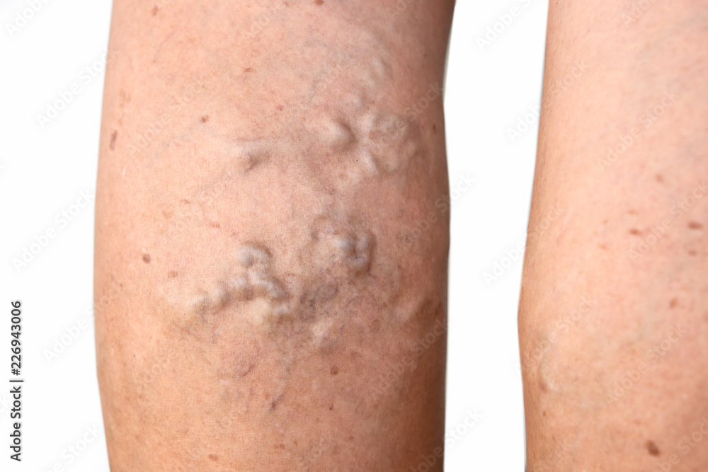 varicose veins on female leg isolated on white background varicose veins on female leg isolated on white background