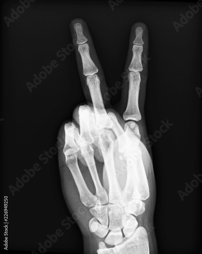 X-ray of the hands