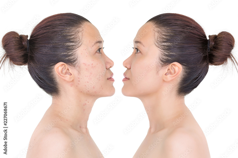 Before and after laser treatment Before and after laser treatment