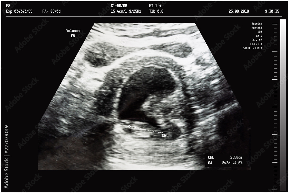 An ultrasound of a mother fetus during the 08th week background as
