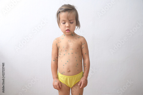 Child with chickenpox. Sick little girl  with varicells making eruption on skin. Long home quarantine, then having immunity for ever. photo