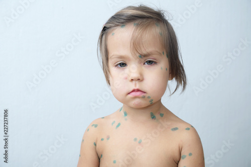 Child portrait with chickenpox. Sick little girl  with varicells making eruption on skin. Long home quarantine, then having immunity for ever. photo