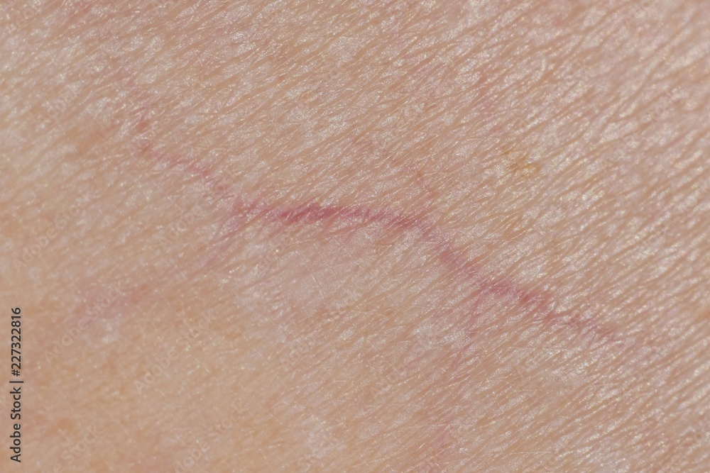 Macro photo of veins on human skin, Microvarices Macro photo of veins on human skin, Microvarices