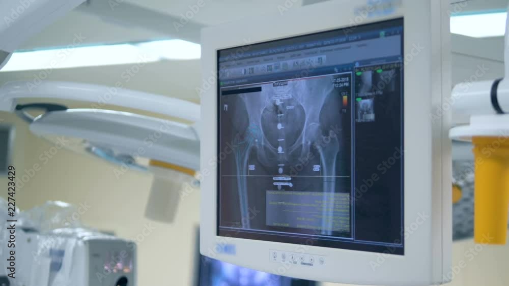 An x-ray shot of patient's hips on a screen in a surgery room. 4K An x-ray shot of patient's hips on a screen in a surgery room. 4K
