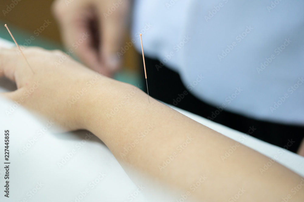 Treatment of Chinese Acupuncture at an arm and hand of a patient.