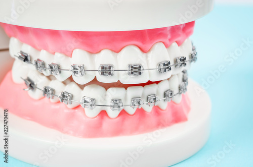 tooth model with metal wire dental braces.