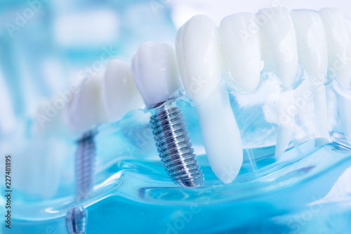 Dentist dental teeth implant photo