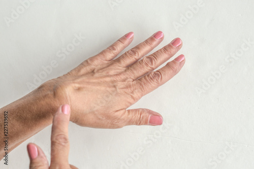 Foto Ganglion Cyst