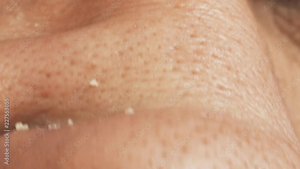 non groomed and ditry male skin with acnes, macro