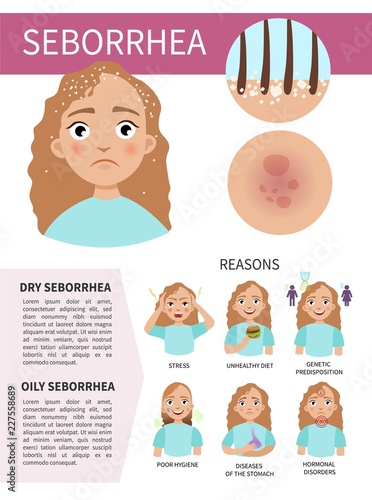 Infographics of seborrhea. Problems with hair and skin. Illustration of a cute girl. Causes of the appearance of the disease.