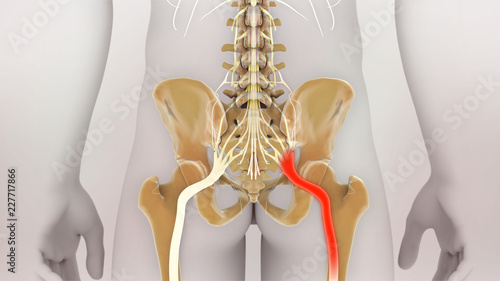 Sciatic Nerve Pain Medical Illustration photo