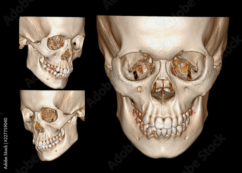 Tablou pe pânză 3D rendering image of Face , Facail bone ,skull front and both side view