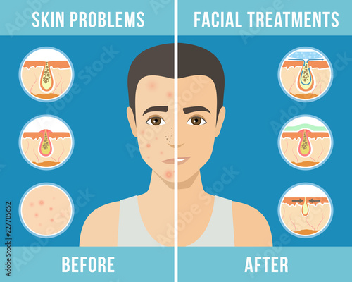 Man with a problem skin. Treatment of acne, skin care, men's cosmetics. Vector
