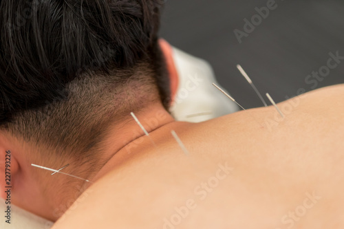 首から肩にかけての鍼治療（男性の背中）