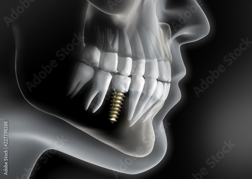 Zahnimplantat - Bildbeispiel photo