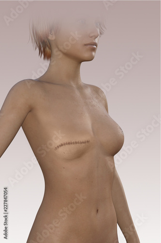 Donna senza seno dopo una mastectomia. Cicatrice sul corpo. Asportazione chirurgica della mammella