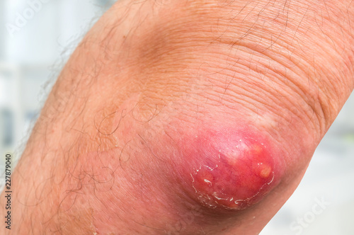 Foto Detailed view of elbow with carbuncle or furuncle