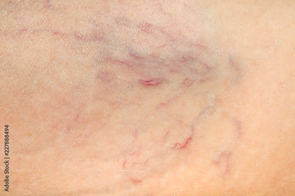 Close-up view of spider veins on female leg
