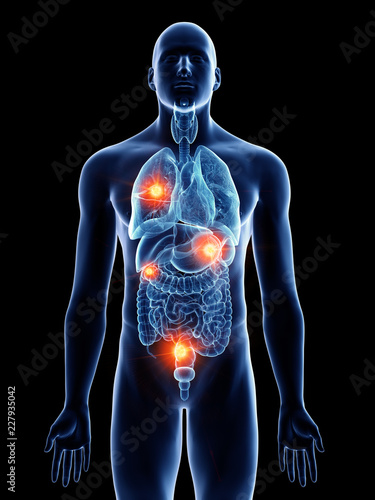 3d rendered medically accurate illustration of a man with metastases photo