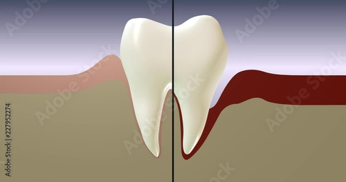 Health care 3d animation.Treatment and progression of periodontal disease, gingivitis and gum inflammation.  Healthy white human tooth anatomical model. Dental products  active action.