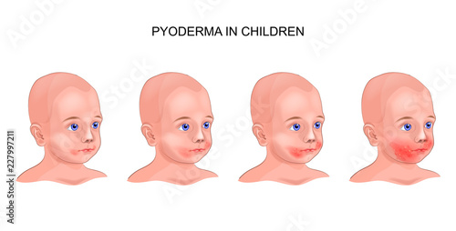pyoderma on the baby's face photo