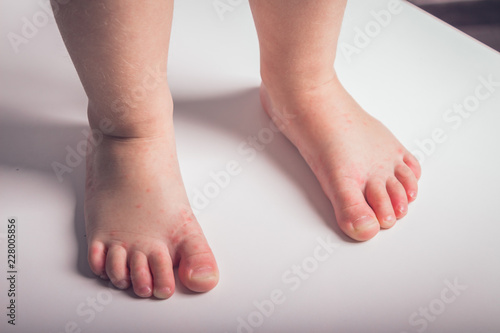 illness, fever, temperature, blisters in a child's arms and feet