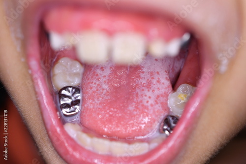 Canvas-taulu Young girl with silver tooth