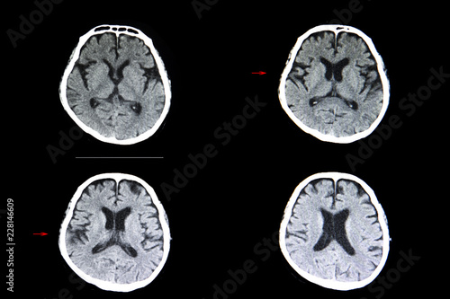 brain atrophy and cerebral infarction