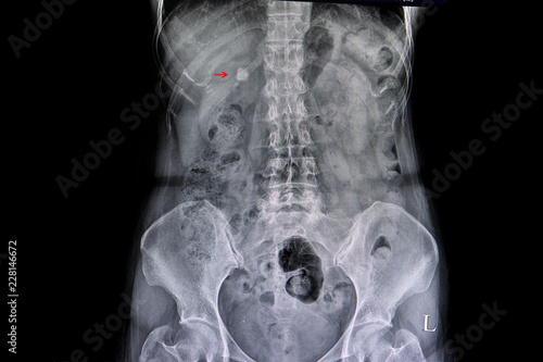 calcified gall bladder stone photo