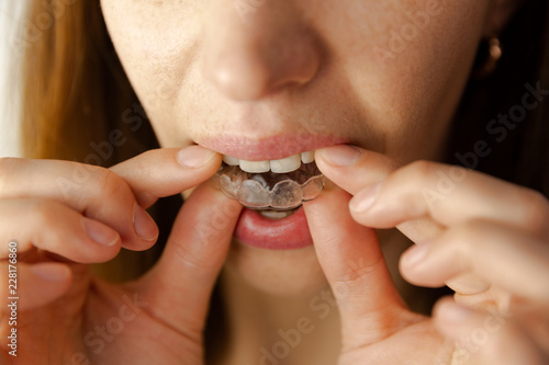 young woman puts transparent aligner for dental treatment photo