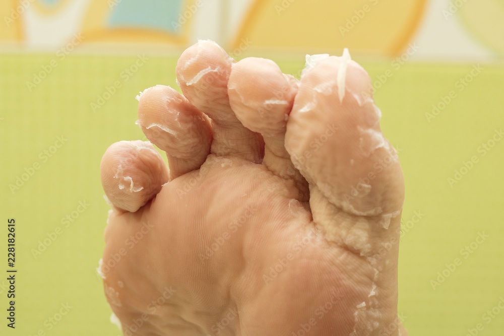 Peeling skin on the toes of a woman. Asian masks for the skin of