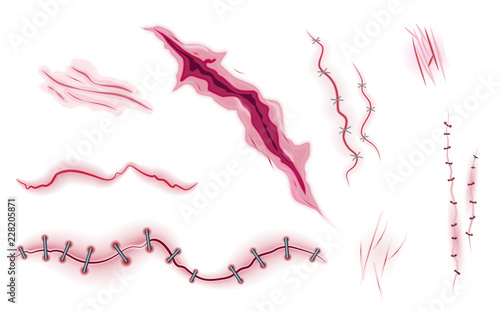  Surgical stitches realistic vector, scars, bruise and slaughter set isolated on the white background. Bloody scar.Medical cut.Pain of human body.Accident recovery in hospital.Care