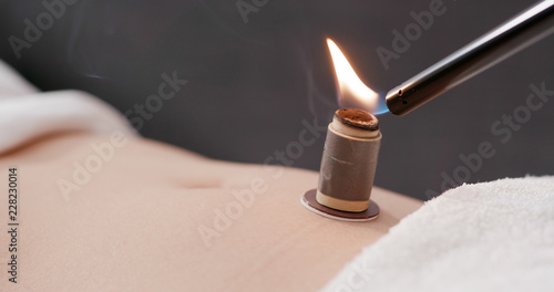 Chinese medicine moxibustion therapy