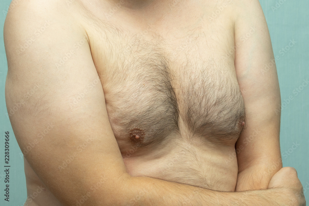 Naklejka premium fat white middle-aged man with Gynecomastia, enlarged breast