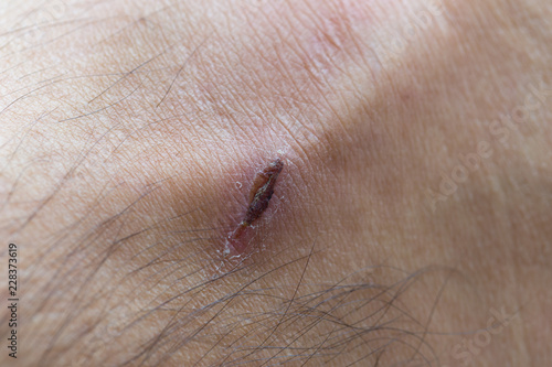 sore skin wound