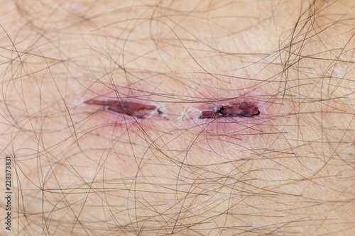sore skin wound