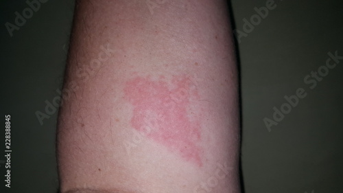 Fotografia an allergic reaction
