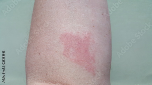 Foto an allergic reaction