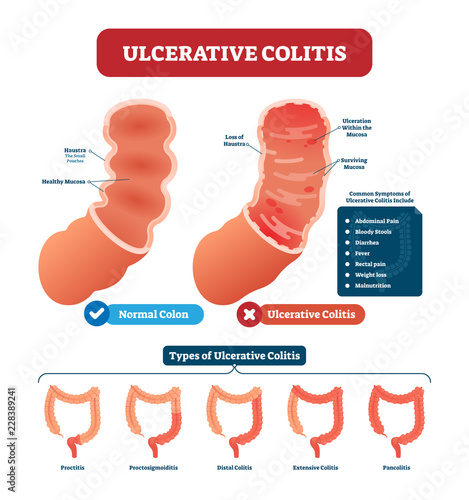Ulcerative colitis vector illustration. Labeled anatomical infographic