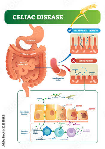 Celiac disease vector illustration. Labeled diagram with its structure photo