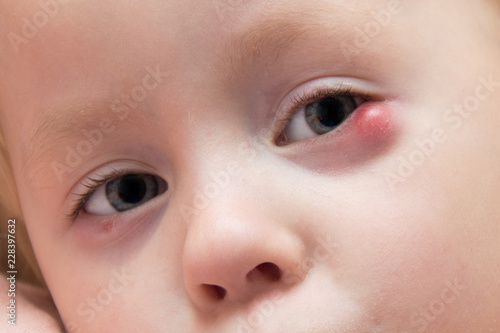 child's eye suffers from ailment photo
