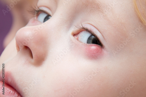 child's eye suffers from ailment photo