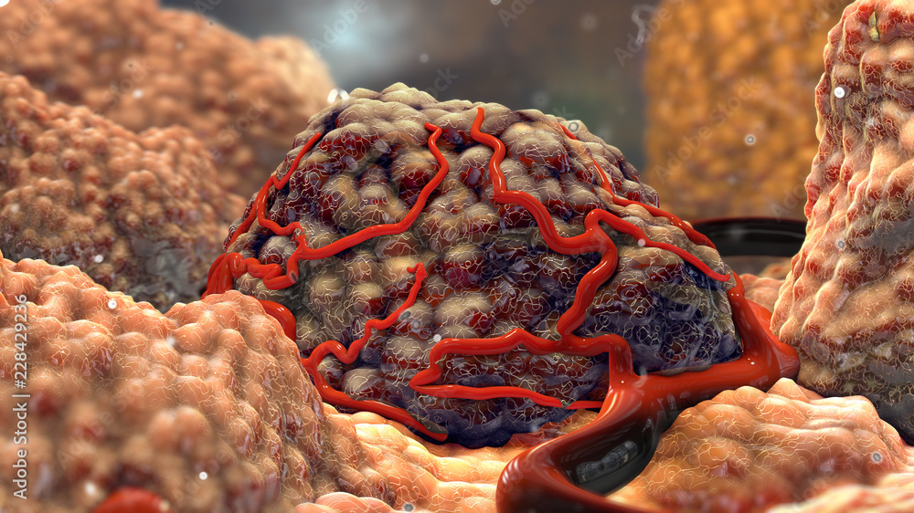 3D Tumor Cancer Cells Stock Illustration Adobe Stock