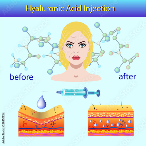 Vector illustration with cosmetic filler or Dermal fillers on light background