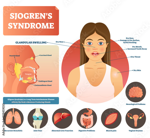 Sjogrens syndrome vector illustration. Dry body autoimmune disease.