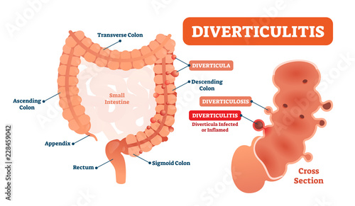 Diverticulitis vector illustration. Labeled diagram with its structure photo