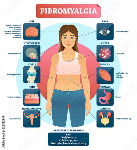 Fibromyalgia vector illustration. Diagnosis symptoms labeled diagram.