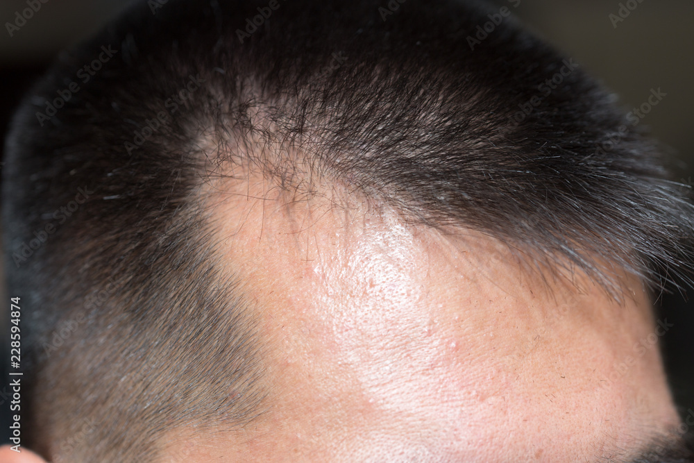 Male head with hair loss symptoms front side Stock Photo | Adobe Stock