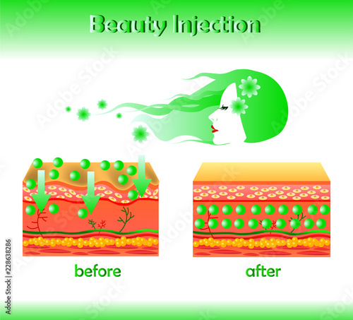 Vector illustration with cosmetic filler or Hyaluronic acid on light background